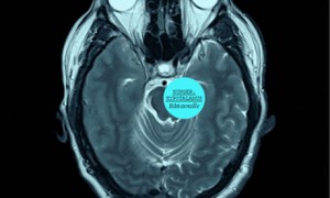 HUNGER: HYPOTALAMUS. Råttatouille